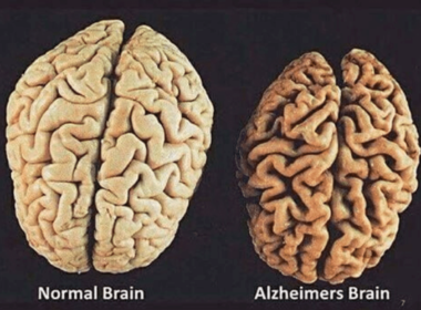 mózg z chorobą alzheimera a zdrowy mózg