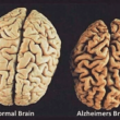mózg z chorobą alzheimera a zdrowy mózg