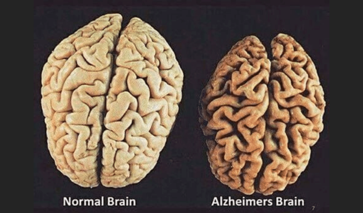 mózg z chorobą alzheimera a zdrowy mózg